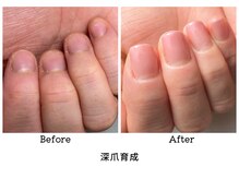 アンベリール(embellir.)/自爪育成/深爪育成/噛み爪