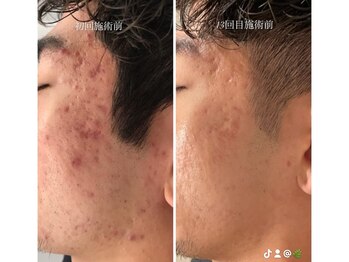 ライフ美容整体院 恵比寿(Life美容整体院)/MEN'S ハーブピーリング