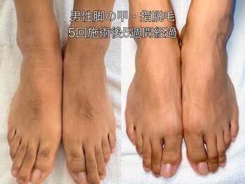 エクレ 柏店(EKURE)/メンズ脚脱毛