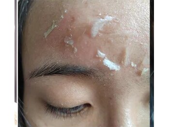 サロンハル(salon HARU)/剥離有り ハーブピーリング