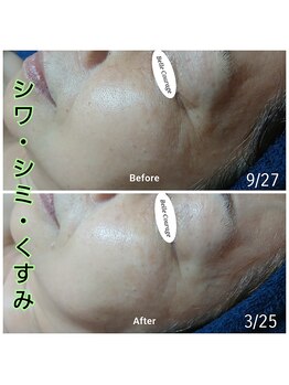 ベルクラージュ(Belle Courage)/60代 シワ・シミ・くすみ