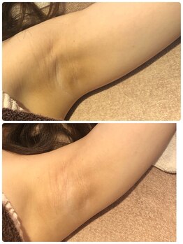 サロンドプレマージュ(Salon de Premage)/脇の黒ずみケア