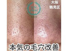 リッカロッカ(RIKKA&ROCCA)/毛穴エクストラクション