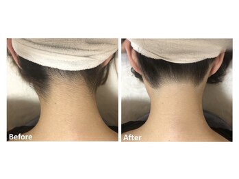 メイ(meiy)/脱毛/えり足/うなじ