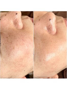 サロンドジョリー/シミ/毛穴開き/目元のシワ改善！