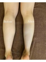 ビオラボ(Bio Labo)/片足施術後のお写真です