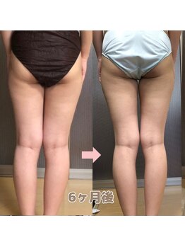 ヨサパーク ブリス(YOSA PARK blis)/20代　6ヶ月