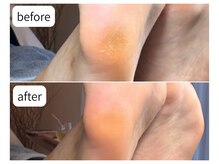 カシェット(Cachette)/40代女性◎足裏角質ケア90分