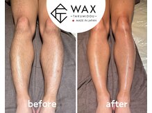 シエルエトワール 唐津店(Ciel Etoile)/匠道 脚(あし)脱毛