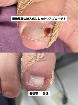 巻き爪じゅん 千葉駅前店/長年の陥入爪痛みと向き合う一歩