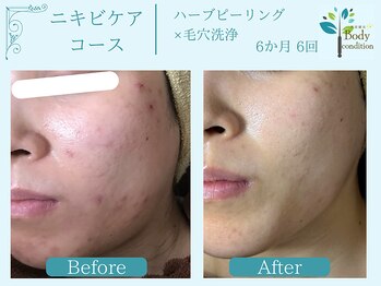 ボディコンディション/ハーブピーリング/毛穴洗浄/小顔