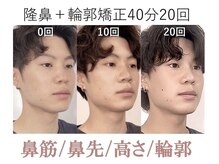 ラプリボヤージュ 藤沢店(Raplit)/隆鼻＋輪郭矯正40分10回以上