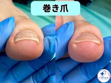プラスワンフット 本厚木(+1 Foot)/軽い巻き爪でも痛い…