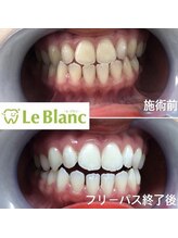 ルブラン 奈良店(Le Blanc)/ホワイトニングの種類