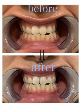 リジュベ(Rejuve)/セルフホワイトニング/メンズ