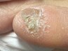 【副爪１箇所 (小指の爪横にあるモノ)】+【初回足の爪切りセット】