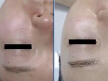 ヴィヴァンビー(Vivant+B)/before/after