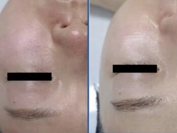 ヴィヴァンビー(Vivant+B)/before/after