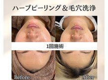 イーラボ 池袋店(e-LABO)/毛穴洗浄×国産ハーブピーリング