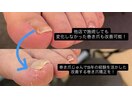 他店で改善しなかった巻き爪！