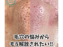 リッカロッカ(RIKKA&ROCCA)/毛穴エクストラクション