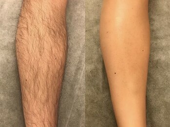 シンボディメイク 恵比寿(SiN BODY MAKE)/メンズひざ下ワックス