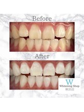 ホワイトニングショップ 秋田店/【before after】 美白
