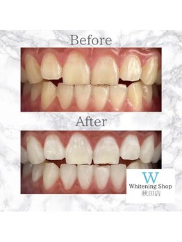 ホワイトニングショップ 秋田店/【before after】 美白