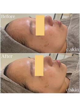シースキン 盛岡駅前店(c.skin)/お客様ビフォーアフター♪