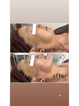 アヤエステティックサロン 綱島店(AYA)/大人気レモンボトル