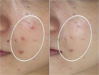 アンリミット 原宿竹下通り店(Une limit)/【繰り返す肌トラブルに】