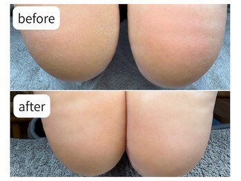 カシェット(Cachette)/20代女性◎足裏角質 かかと40分