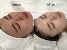 リフコウベ(LIF KOBE)/くすみ、茶色の跡、美白悩みに^^