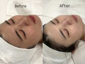 リフコウベ(LIF KOBE)/くすみ、茶色の跡、美白悩みに^^