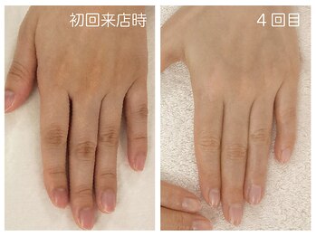 キレイテ 福岡天神店/30代/4回目【福岡ハンドケア】