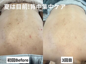 ワイシーハッチ(yc.hacci)の写真/《ブライダル,夏に向けて背中ケア★》自分ではケアが難しい背中をハーブピーリングで綺麗に!毛穴・ニキビ◎