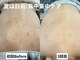 ワイシーハッチ(yc.hacci)の写真/《ブライダル,夏に向けて背中ケア★》自分ではケアが難しい背中をハーブピーリングで綺麗に!毛穴・ニキビ◎