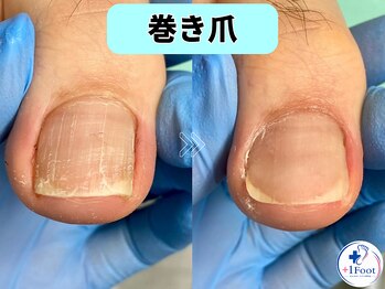 プラスワンフット 本厚木(+1 Foot)/軽い巻き爪でも痛い…