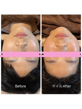 鍼灸院 はりのひと/美容鍼×整顔トリートメント1回