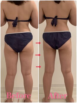 スペチアーレ 夙川/痩せにくい所に効果的