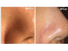 ラリリー(La Lily)/毛穴キレイ