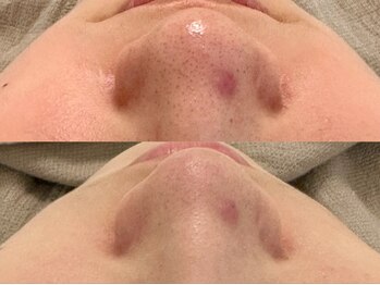 ピブ(PIBU)/ニキビ×黒ずみ症例