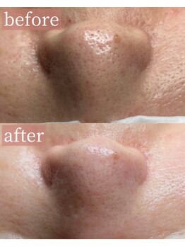 アディクトウラ(Addict'ula)/毛穴エクストラクション