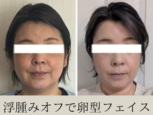 オルビナ(Orbina)/小顔矯正