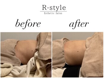 エステサロン アールスタイル(R-style)/テスラスカルプトビフォア写真