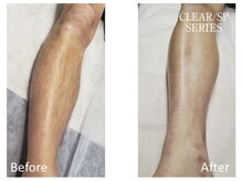 ベルフィオーレ(bel fiore)/メンズ脱毛　足