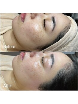 イーズ(eees)/ウルツヤ毛穴ケアの施術後