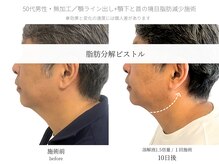 サボラミ(sabor A Mi)/顎下と首の間のお肉も落とせます
