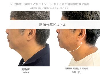 サボラミ(sabor A Mi)/顎下と首の間のお肉も落とせます