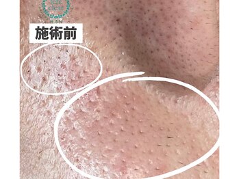 リッカロッカ(RIKKA&ROCCA)/施術前